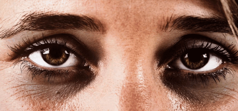 ¿Tienes ojeras? Aprende lo esencial para disminuir su aparición y tratarlas