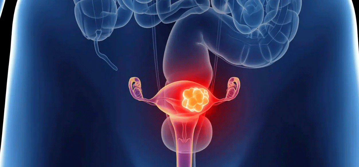 Estudio descubre el factor vital en cáncer de ovario agresivo