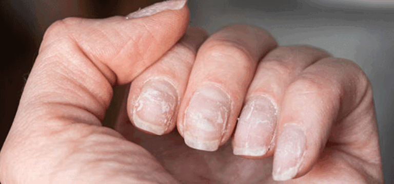 Descubre cuál es significado de manchas en las uñas