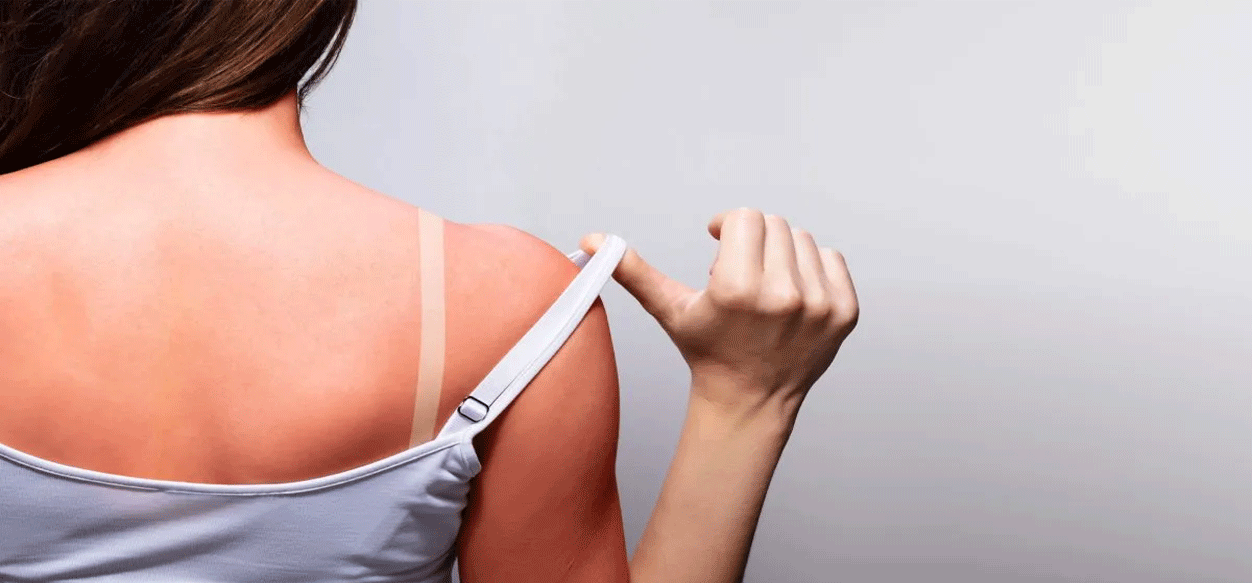 Qué hacer y qué no para tratar una quemadura solar