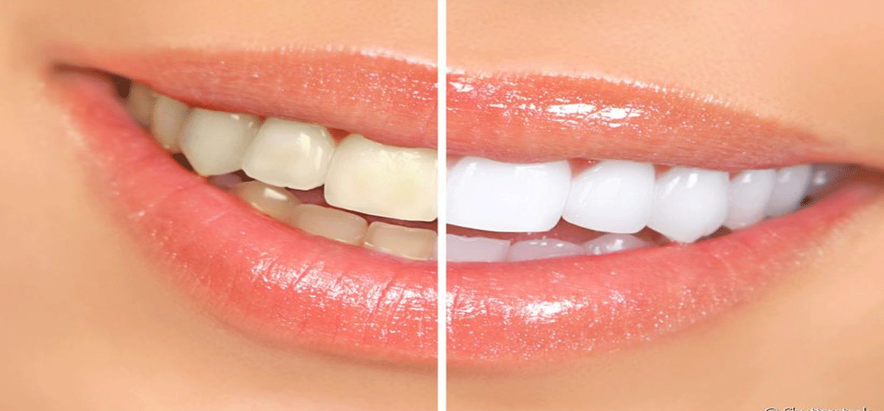 Consejos para remover la placa dental naturalmente